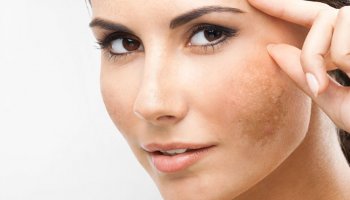 Melasma: disfunção estética